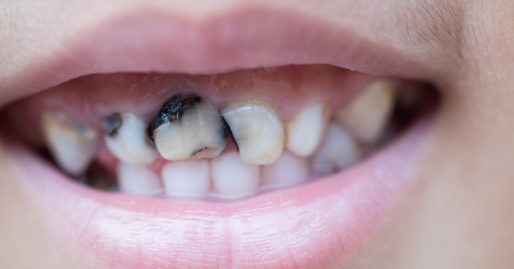 لا تزال هيئة المحلفين خارج النقاش حول ما إذا كانت الحلويات هي السبب الرئيسي لتسوس الأسنان أم لا. في حين أنه من الصحيح أن السكر يمكن أن يساهم في تكوين التجاويف، إلا أن هناك عوامل أخرى تلعب دورًا أيضًا. على سبيل المثال، يمكن أن يؤدي سوء نظافة الأسنان وعدم الحصول على ما يكفي من الفلورايد إلى تسوس الأسنان.